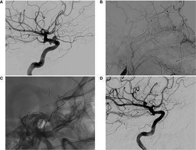 A novel endovascular treatment for true ophthalmic aneurysms: A case report